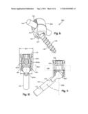 Polyaxial Bone Anchors with Increased Angulation diagram and image