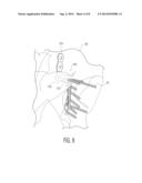 PELVIC BONE PLATE diagram and image