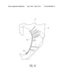 PELVIC BONE PLATE diagram and image