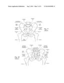 SYSTEMS AND METHODS FOR THE FIXATION OR FUSION OF BONE USING COMPRESSIVE     IMPLANTS diagram and image