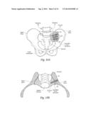 SYSTEMS AND METHODS FOR THE FIXATION OR FUSION OF BONE USING COMPRESSIVE     IMPLANTS diagram and image