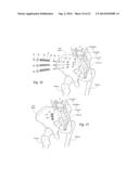 SYSTEMS AND METHODS FOR THE FIXATION OR FUSION OF BONE USING COMPRESSIVE     IMPLANTS diagram and image