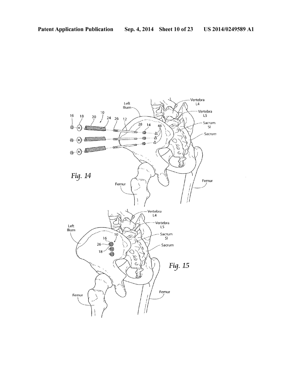 SYSTEMS AND METHODS FOR THE FIXATION OR FUSION OF BONE USING COMPRESSIVE     IMPLANTS - diagram, schematic, and image 11