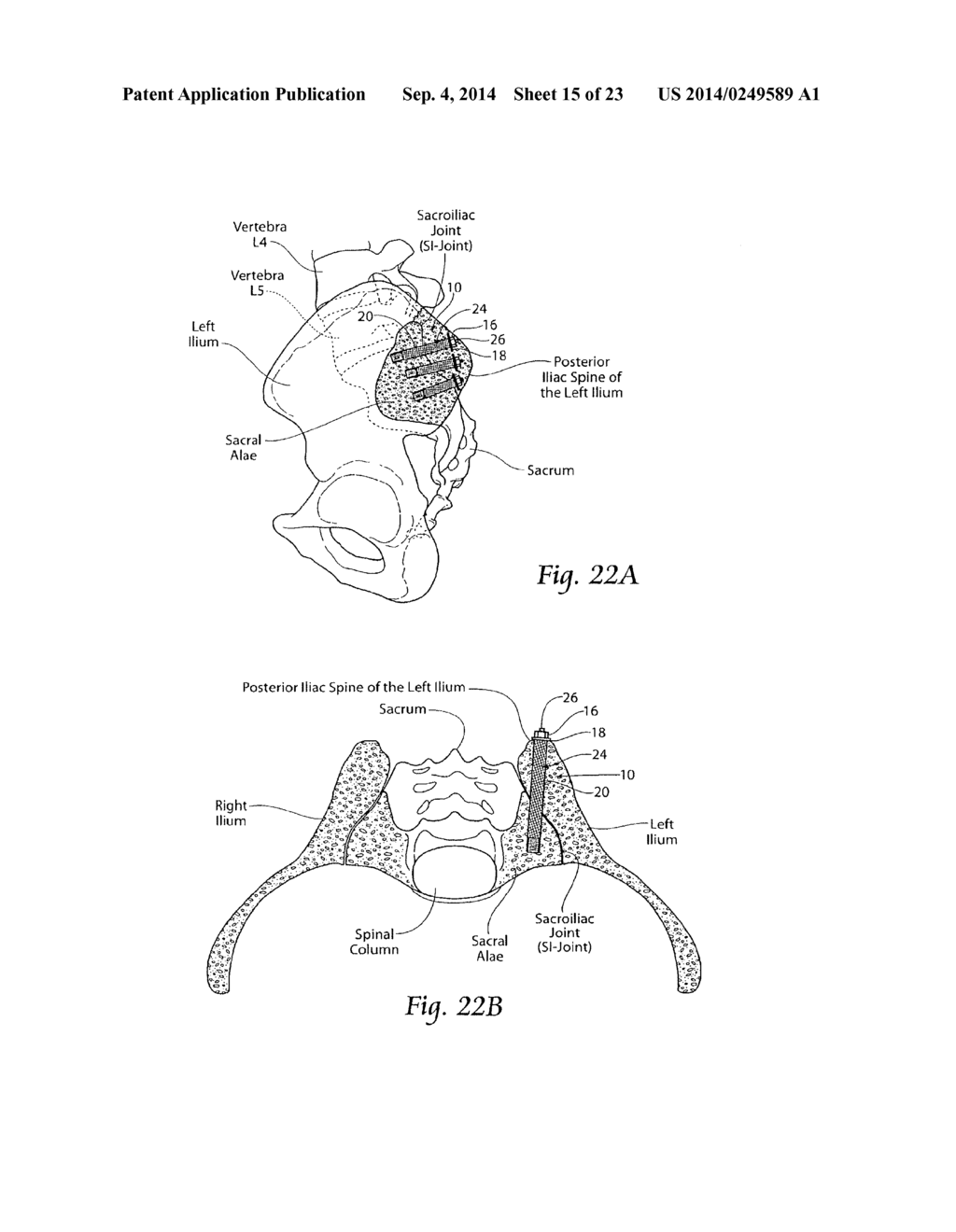 SYSTEMS AND METHODS FOR THE FIXATION OR FUSION OF BONE USING COMPRESSIVE     IMPLANTS - diagram, schematic, and image 16