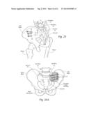 SYSTEMS AND METHODS FOR THE FIXATION OR FUSION OF BONE USING COMPRESSIVE     IMPLANTS diagram and image