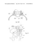 SYSTEMS AND METHODS FOR THE FIXATION OR FUSION OF BONE USING COMPRESSIVE     IMPLANTS diagram and image