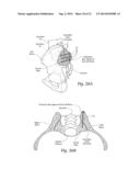 SYSTEMS AND METHODS FOR THE FIXATION OR FUSION OF BONE USING COMPRESSIVE     IMPLANTS diagram and image