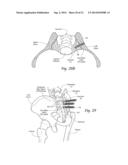 SYSTEMS AND METHODS FOR THE FIXATION OR FUSION OF BONE USING COMPRESSIVE     IMPLANTS diagram and image