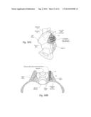 SYSTEMS AND METHODS FOR THE FIXATION OR FUSION OF BONE USING COMPRESSIVE     IMPLANTS diagram and image