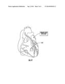 SITE SPECIFIC DRUG DELIVERY WRAPS, SYSTEMS AND METHODS OF USE THEREOF diagram and image