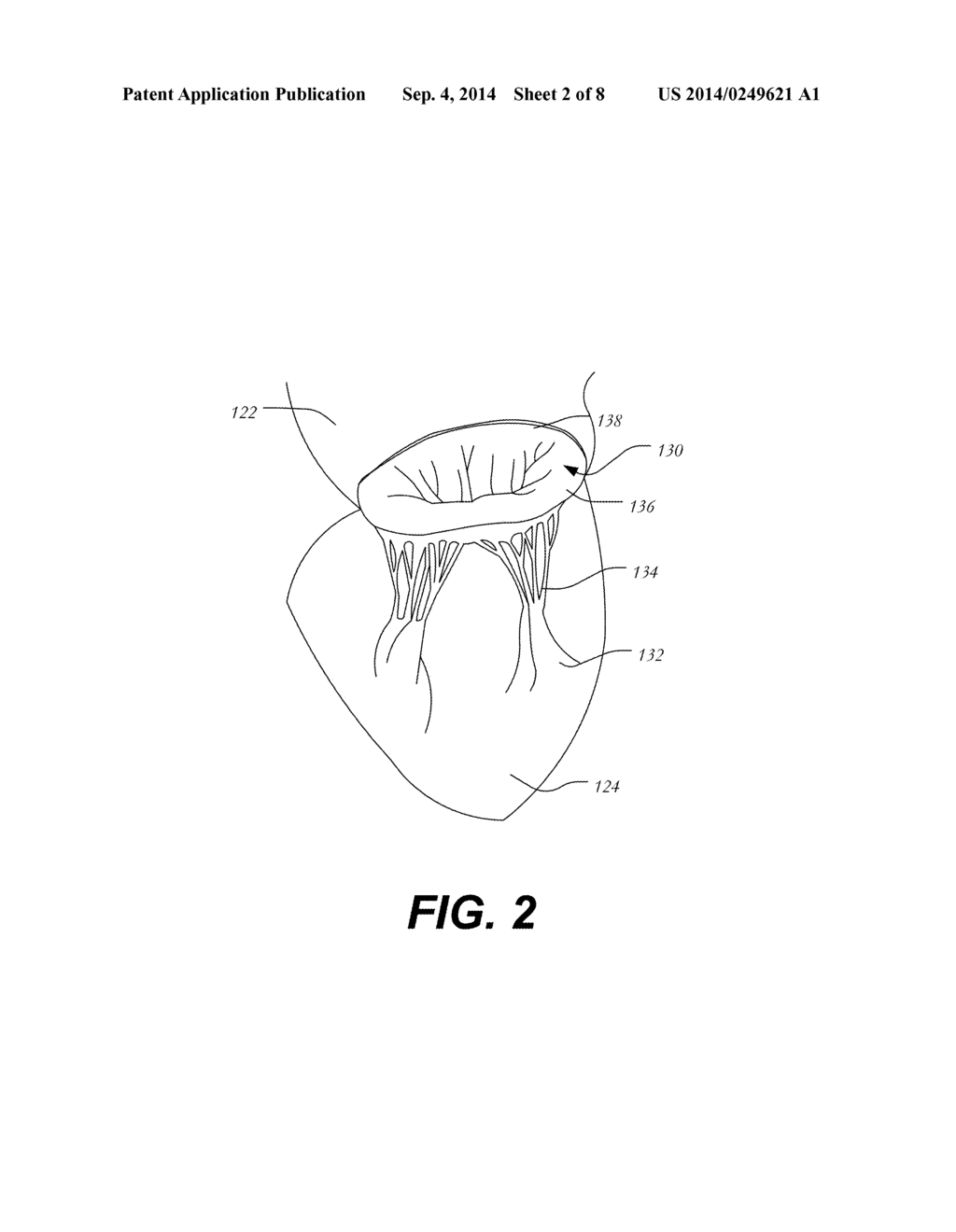 Transapical Mitral Valve Replacement - diagram, schematic, and image 03