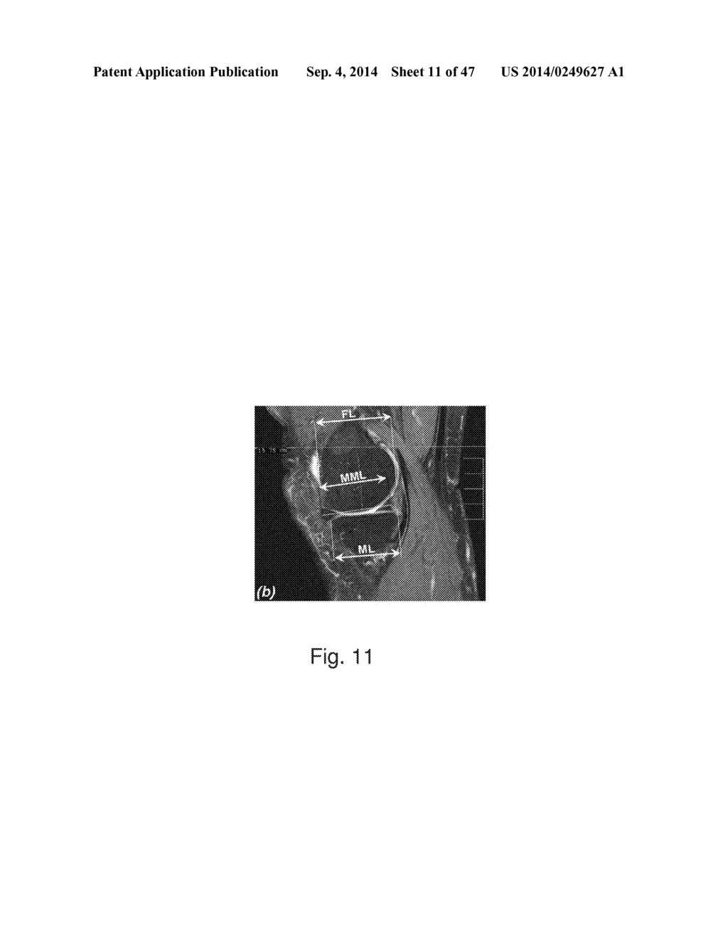 Devices, Methods, and Systems for Prosthetic Meniscus Selection, Trialing,     and Implantation - diagram, schematic, and image 12