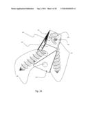 ZERO-PROFILE EXPANDABLE INTERVERTEBRAL SPACER DEVICES FOR DISTRACTION AND     SPINAL FUSION AND A UNIVERSAL TOOL FOR THEIR PLACEMENT AND EXPANSION diagram and image