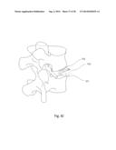 ZERO-PROFILE EXPANDABLE INTERVERTEBRAL SPACER DEVICES FOR DISTRACTION AND     SPINAL FUSION AND A UNIVERSAL TOOL FOR THEIR PLACEMENT AND EXPANSION diagram and image