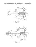 TISSUE PROSTHESIS INSERTION SYSTEM AND METHOD diagram and image