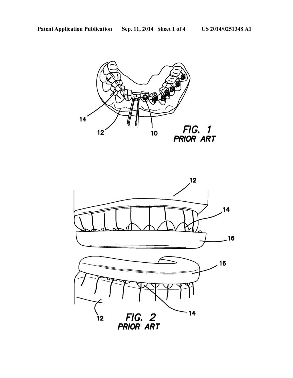 Method for Making and Using a Comfort Guard for Orthodontic Treatments - diagram, schematic, and image 02