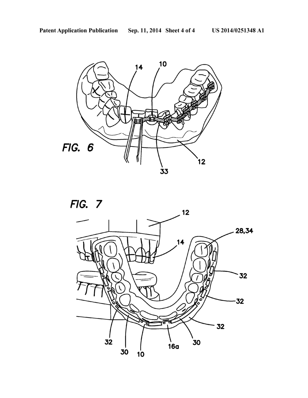 Method for Making and Using a Comfort Guard for Orthodontic Treatments - diagram, schematic, and image 05