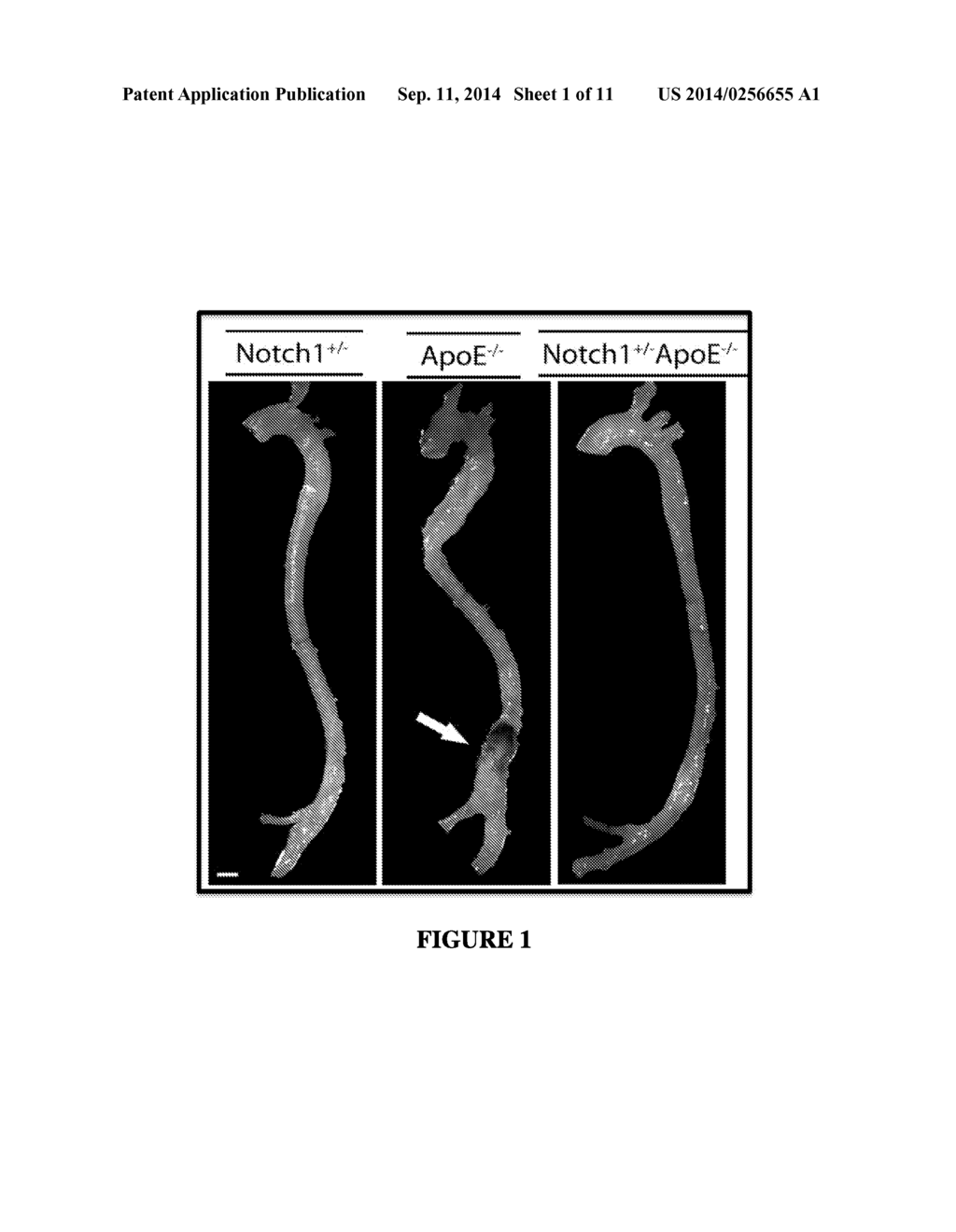 PRODUCTS AND METHODS FOR AORTIC ABDOMINAL ANEURYSM - diagram, schematic, and image 02