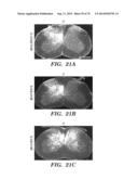 CO-ACTIVATION OF MTOR AND STAT3 PATHWAYS TO PROMOTE NEURONAL SURVIVAL AND     REGENERATION diagram and image