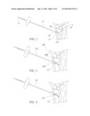 BONE FRACTURE REDUCTION SYSTEM AND METHODS OF USING THE SAME diagram and image