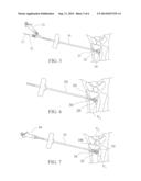 BONE FRACTURE REDUCTION SYSTEM AND METHODS OF USING THE SAME diagram and image