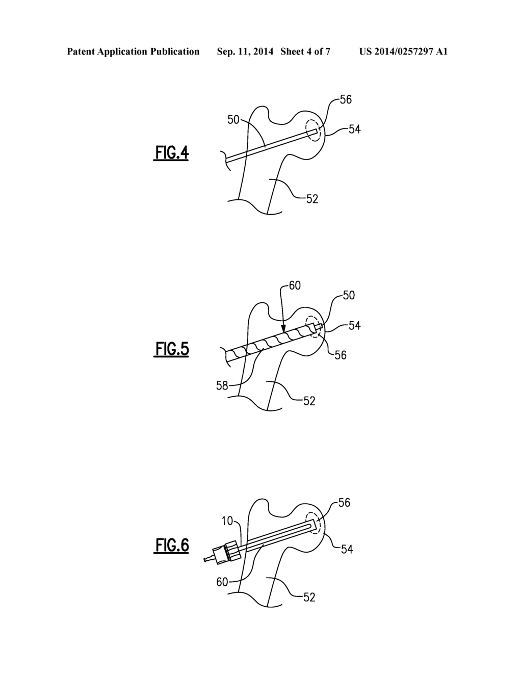 EXPANDABLE REAMER - diagram, schematic, and image 05