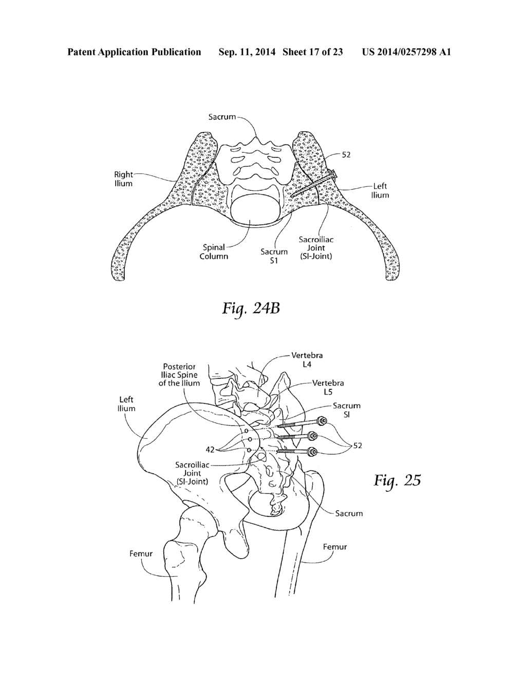 SYSTEMS AND METHODS FOR THE FUSION OF THE SACRAL-ILIAC JOINT - diagram, schematic, and image 18