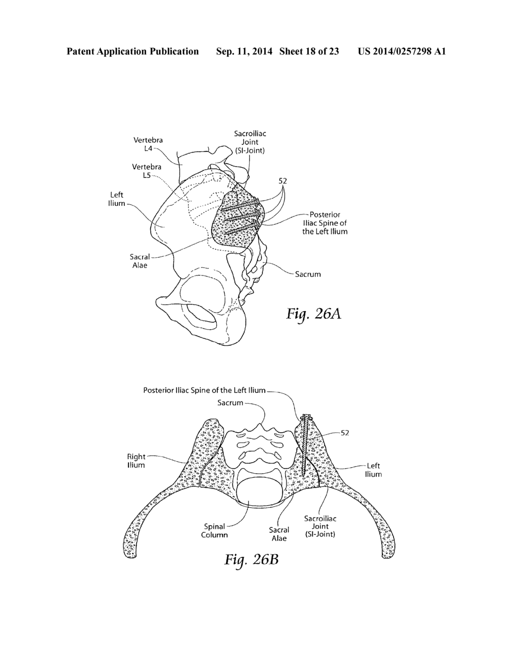 SYSTEMS AND METHODS FOR THE FUSION OF THE SACRAL-ILIAC JOINT - diagram, schematic, and image 19