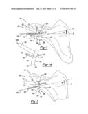 Patient-Specific Glenoid Guide With a Reusable Guide Holder diagram and image