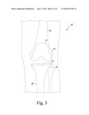 CUSTOMIZED PATIENT-SPECIFIC REVISION SURGICAL INSTRUMENTS AND METHOD diagram and image