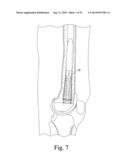 CUSTOMIZED PATIENT-SPECIFIC REVISION SURGICAL INSTRUMENTS AND METHOD diagram and image