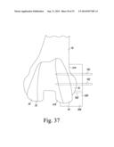 CUSTOMIZED PATIENT-SPECIFIC REVISION SURGICAL INSTRUMENTS AND METHOD diagram and image