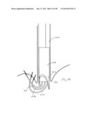 METHODS AND DEVICES FOR MANIPULATING AND FASTENING TISSUE diagram and image