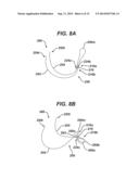 Implant Having Adjustable Filament Coils diagram and image