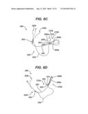 Implant Having Adjustable Filament Coils diagram and image