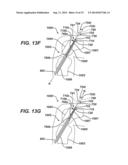 Implant Having Adjustable Filament Coils diagram and image