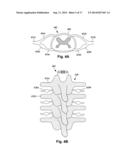 SYSTEMS AND METHODS FOR ELECTRICALLY STIMULATING PATIENT TISSUE ON OR     AROUND ONE OR MORE BONY STRUCTURES diagram and image