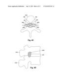 SYSTEMS AND METHODS FOR ELECTRICALLY STIMULATING PATIENT TISSUE ON OR     AROUND ONE OR MORE BONY STRUCTURES diagram and image