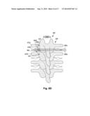 SYSTEMS AND METHODS FOR ELECTRICALLY STIMULATING PATIENT TISSUE ON OR     AROUND ONE OR MORE BONY STRUCTURES diagram and image