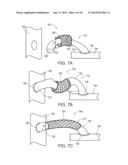 METHODS OF SUPPORTING A VEIN diagram and image