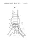 Endovascular Grafts for Treating the Iliac Arteries and Methods of     Delivery and Deployment Thereof diagram and image