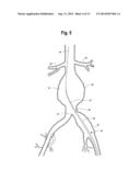 Endovascular Grafts for Treating the Iliac Arteries and Methods of     Delivery and Deployment Thereof diagram and image