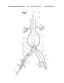 Endovascular Grafts for Treating the Iliac Arteries and Methods of     Delivery and Deployment Thereof diagram and image