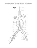 Endovascular Grafts for Treating the Iliac Arteries and Methods of     Delivery and Deployment Thereof diagram and image