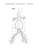 Endovascular Grafts for Treating the Iliac Arteries and Methods of     Delivery and Deployment Thereof diagram and image