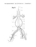 Endovascular Grafts for Treating the Iliac Arteries and Methods of     Delivery and Deployment Thereof diagram and image