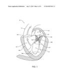 PROSTHETIC VALVE WITH ANTI-PIVOTING MECHANISM diagram and image