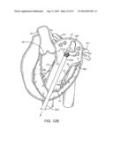 PROSTHETIC VALVE WITH ANTI-PIVOTING MECHANISM diagram and image