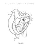 PROSTHETIC VALVE WITH ANTI-PIVOTING MECHANISM diagram and image