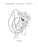 PROSTHETIC VALVE WITH ANTI-PIVOTING MECHANISM diagram and image